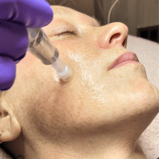 Microneedling at Esthetics With Candise in Omaha, NE
