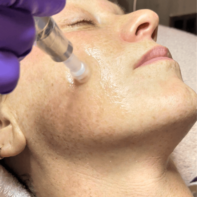 Microneedling Package at Esthetics With Candise in Omaha, NE